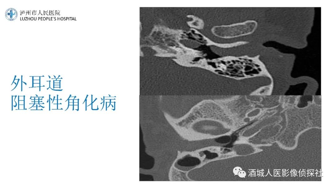 影像PPT - 【PPT】传导性耳聋的CT诊断-54