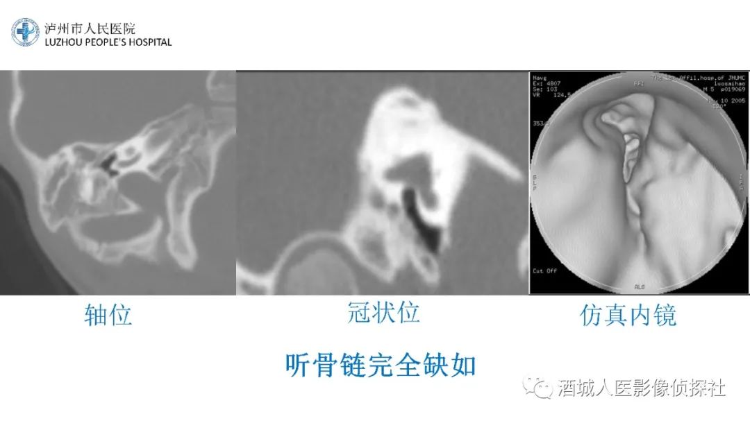 影像PPT - 【PPT】传导性耳聋的CT诊断-78