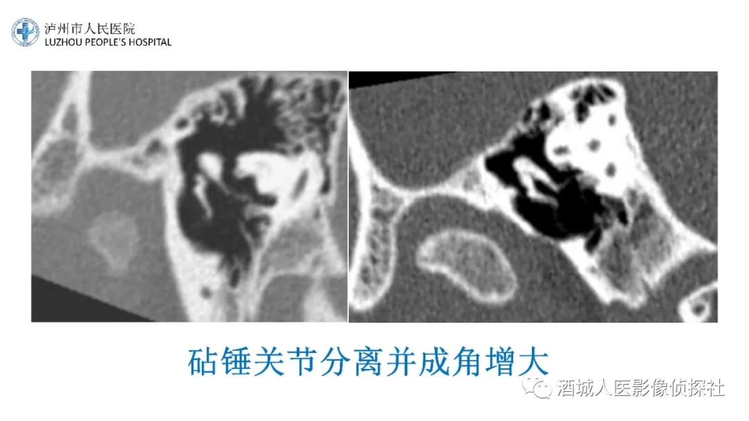 影像PPT - 【PPT】传导性耳聋的CT诊断-83