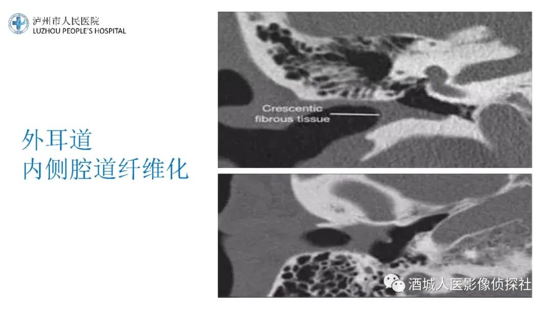 影像PPT - 【PPT】传导性耳聋的CT诊断-51