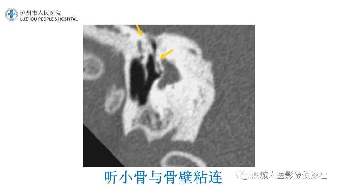 影像PPT - 【PPT】传导性耳聋的CT诊断-86