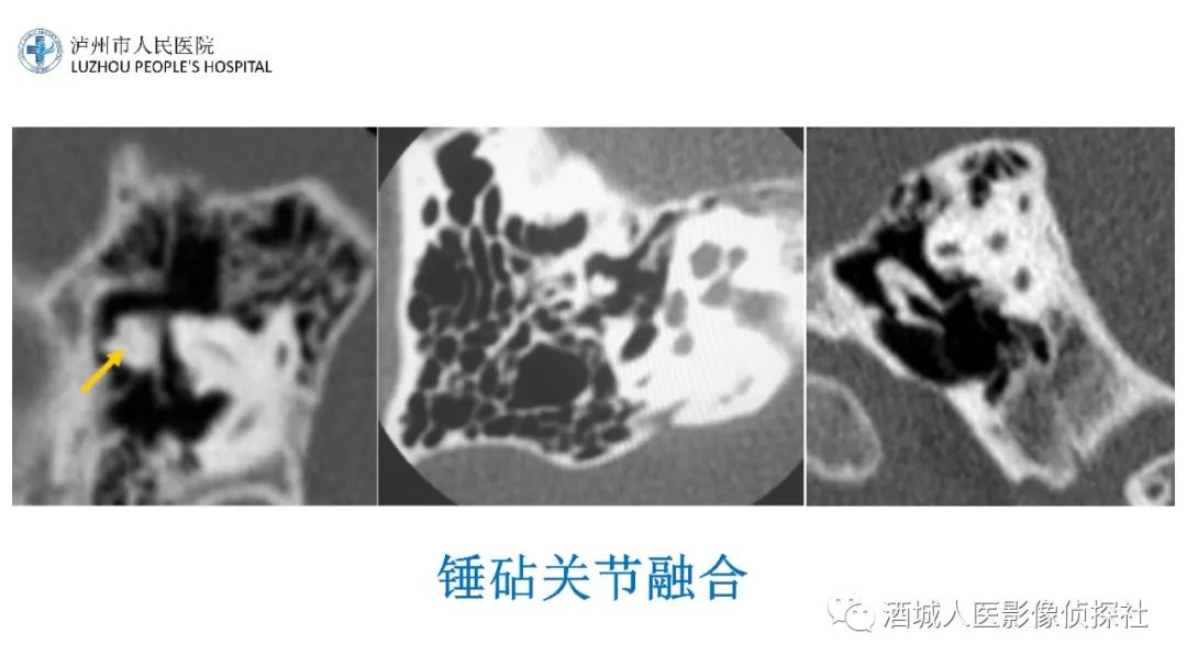 影像PPT - 【PPT】传导性耳聋的CT诊断-76