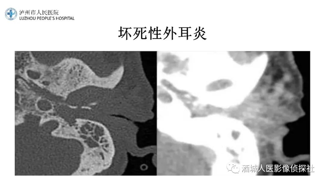 影像PPT - 【PPT】传导性耳聋的CT诊断-45
