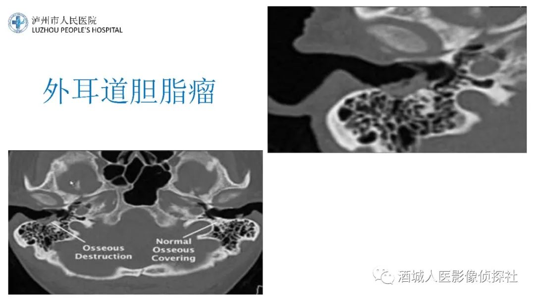 影像PPT - 【PPT】传导性耳聋的CT诊断-58