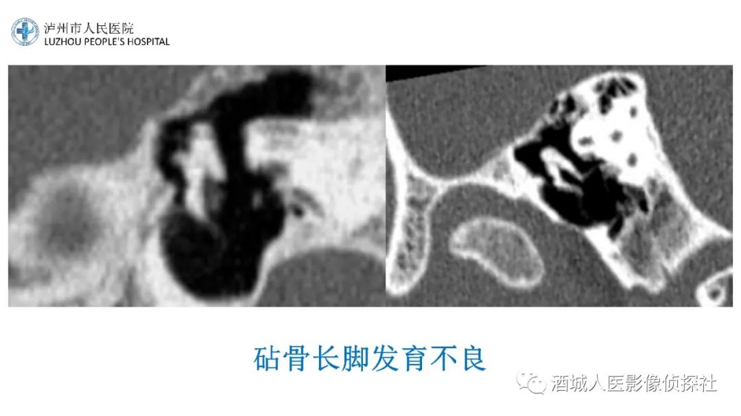 影像PPT - 【PPT】传导性耳聋的CT诊断-81