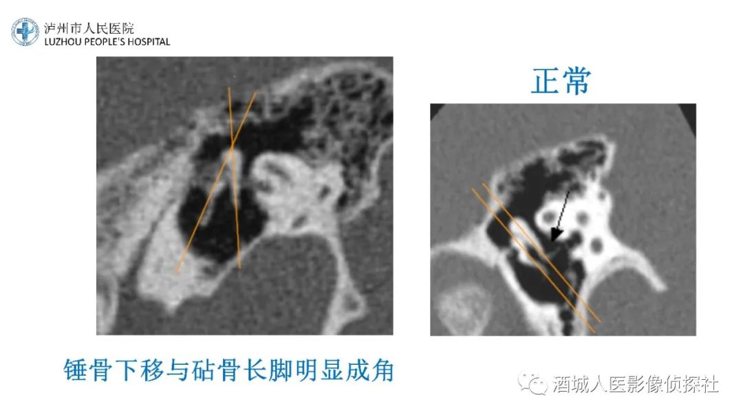 影像PPT - 【PPT】传导性耳聋的CT诊断-77