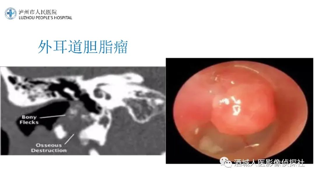 影像PPT - 【PPT】传导性耳聋的CT诊断-57