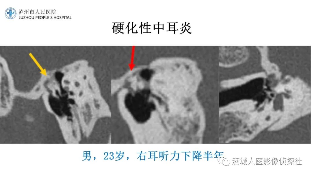 影像PPT - 【PPT】传导性耳聋的CT诊断-89