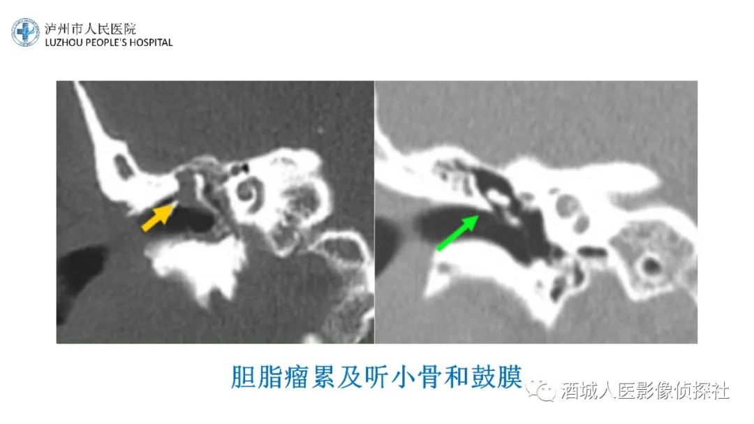 影像PPT - 【PPT】传导性耳聋的CT诊断-90