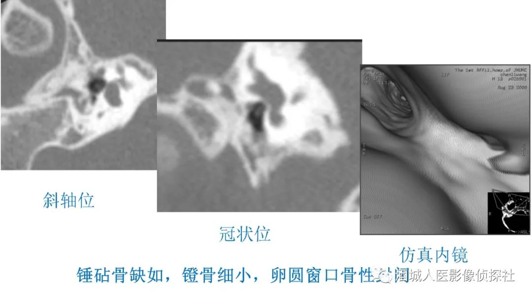 影像PPT - 【PPT】传导性耳聋的CT诊断-79