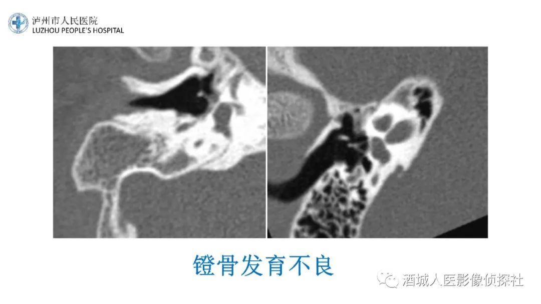 影像PPT - 【PPT】传导性耳聋的CT诊断-85