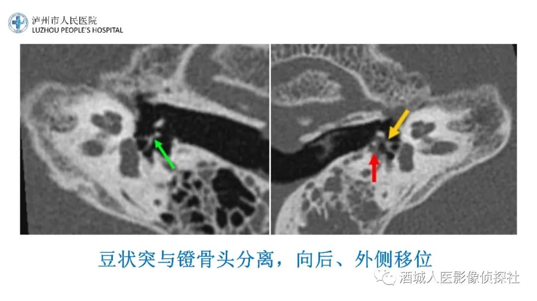 影像PPT - 【PPT】传导性耳聋的CT诊断-80