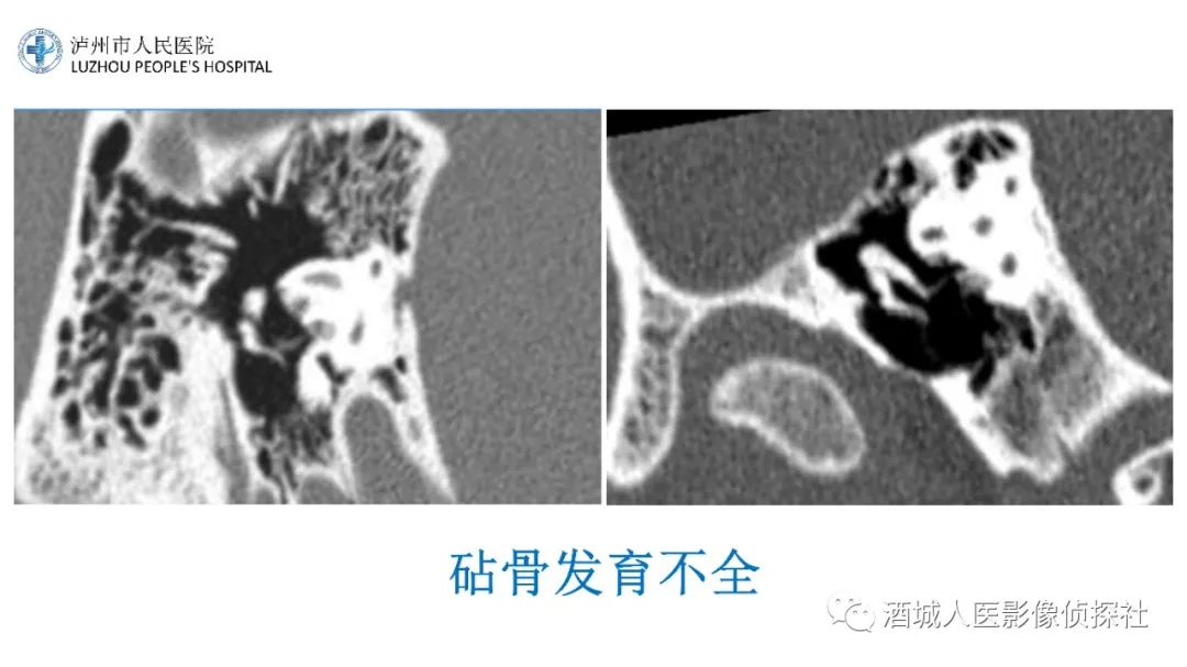 影像PPT - 【PPT】传导性耳聋的CT诊断-82