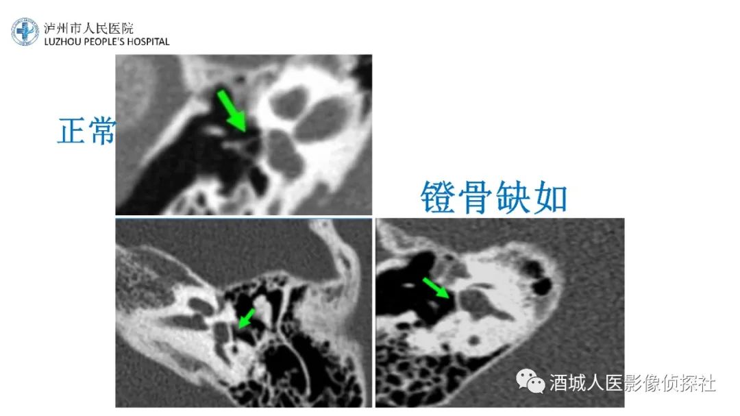 影像PPT - 【PPT】传导性耳聋的CT诊断-84