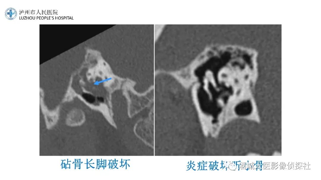 影像PPT - 【PPT】传导性耳聋的CT诊断-88