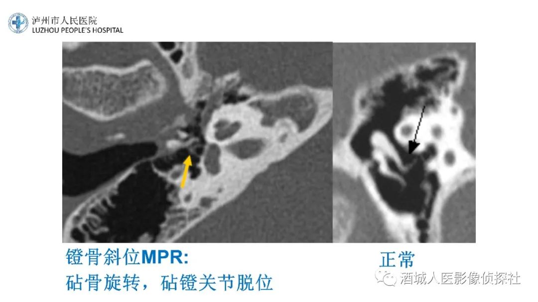 影像PPT - 【PPT】传导性耳聋的CT诊断-94