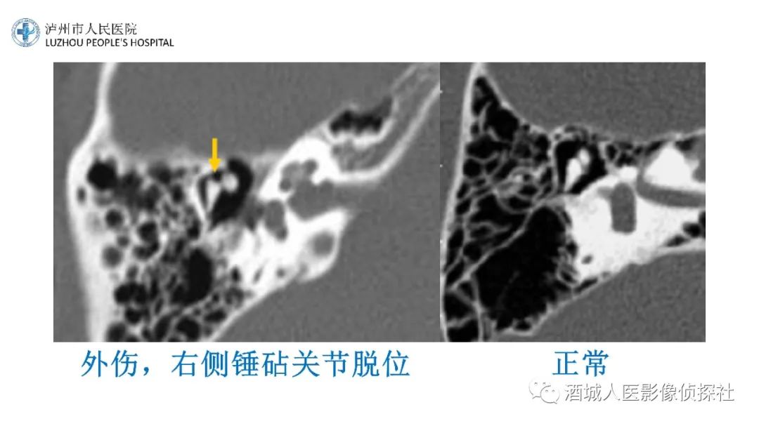 影像PPT - 【PPT】传导性耳聋的CT诊断-93