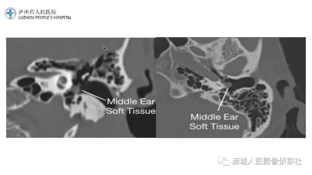 影像PPT - 【PPT】传导性耳聋的CT诊断-108