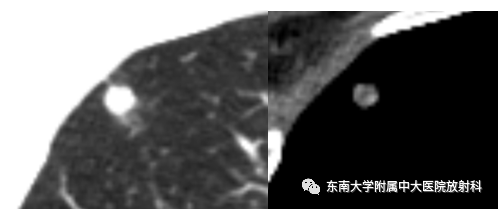 影像PPT - 【PPT】肺结节的鉴别诊断-2 影像PPT - 【PPT】肺结节的鉴别诊断-2