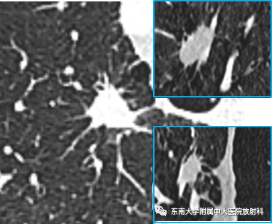 影像PPT - 【PPT】肺结节的鉴别诊断-3 影像PPT - 【PPT】肺结节的鉴别诊断-3