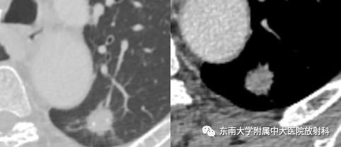 影像PPT - 【PPT】肺结节的鉴别诊断-1 影像PPT - 【PPT】肺结节的鉴别诊断-1
