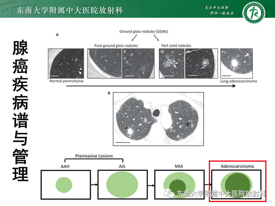 影像PPT - 【PPT】肺结节的鉴别诊断-8 影像PPT - 【PPT】肺结节的鉴别诊断-8