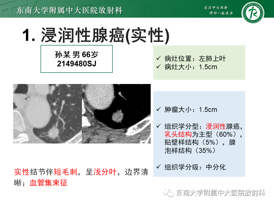 影像PPT - 【PPT】肺结节的鉴别诊断-11 影像PPT - 【PPT】肺结节的鉴别诊断-11
