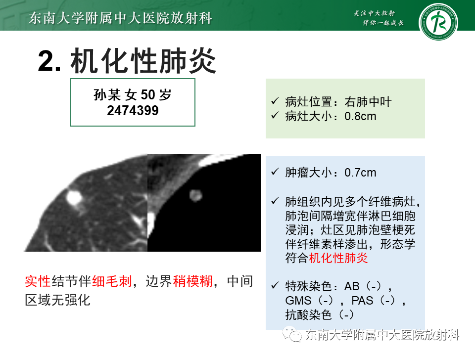 影像PPT - 【PPT】肺结节的鉴别诊断-12 影像PPT - 【PPT】肺结节的鉴别诊断-12