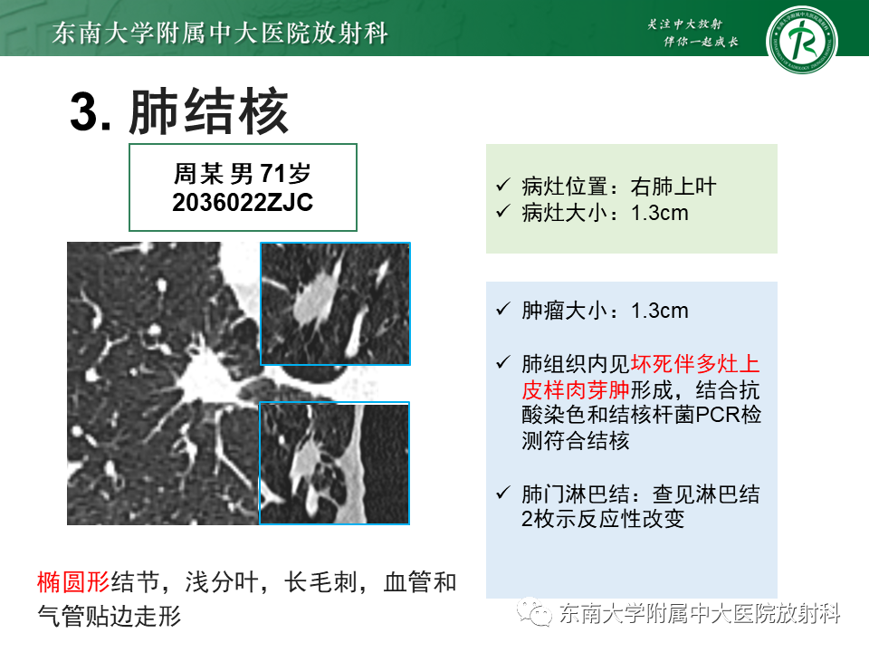 影像PPT - 【PPT】肺结节的鉴别诊断-13 影像PPT - 【PPT】肺结节的鉴别诊断-13