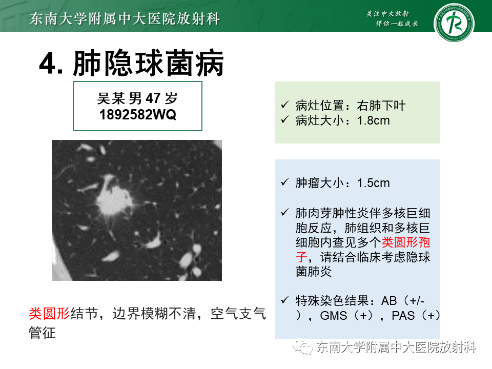 影像PPT - 【PPT】肺结节的鉴别诊断-14 影像PPT - 【PPT】肺结节的鉴别诊断-14