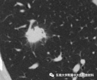 影像PPT - 【PPT】肺结节的鉴别诊断-4 影像PPT - 【PPT】肺结节的鉴别诊断-4