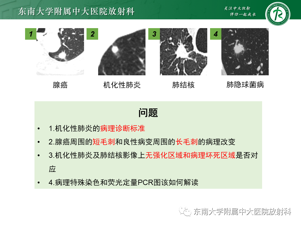 影像PPT - 【PPT】肺结节的鉴别诊断-16 影像PPT - 【PPT】肺结节的鉴别诊断-16