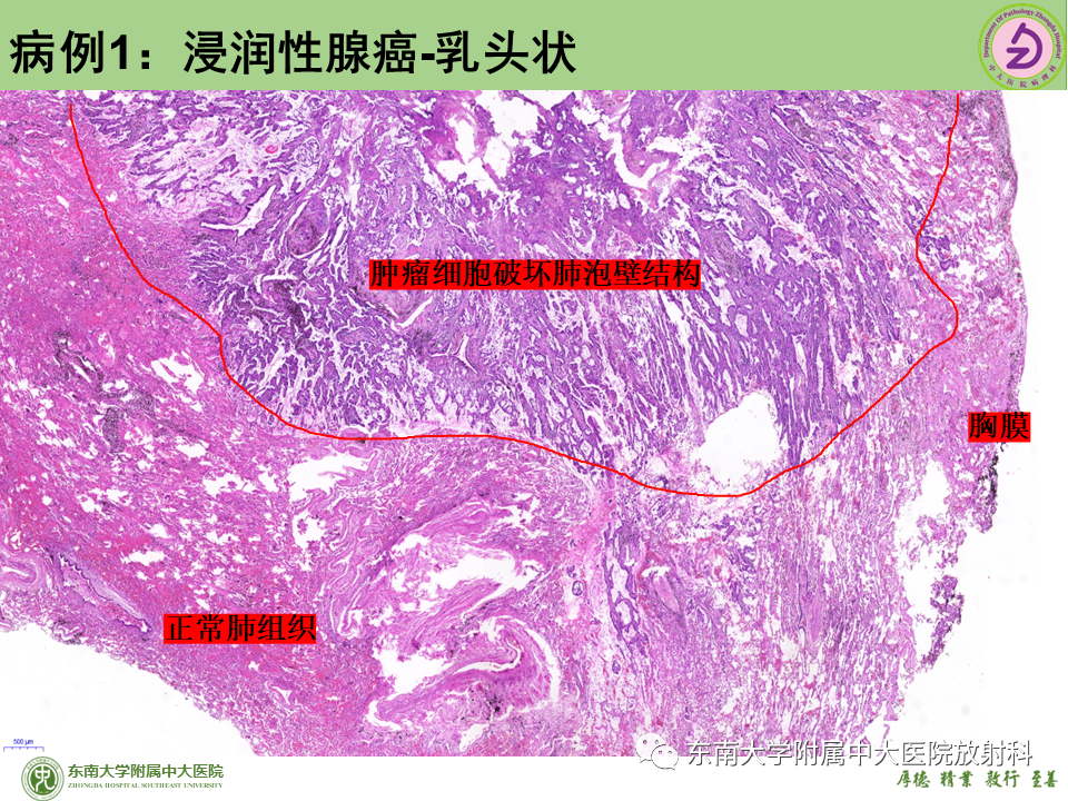 影像PPT - 【PPT】肺结节的鉴别诊断-18 影像PPT - 【PPT】肺结节的鉴别诊断-18