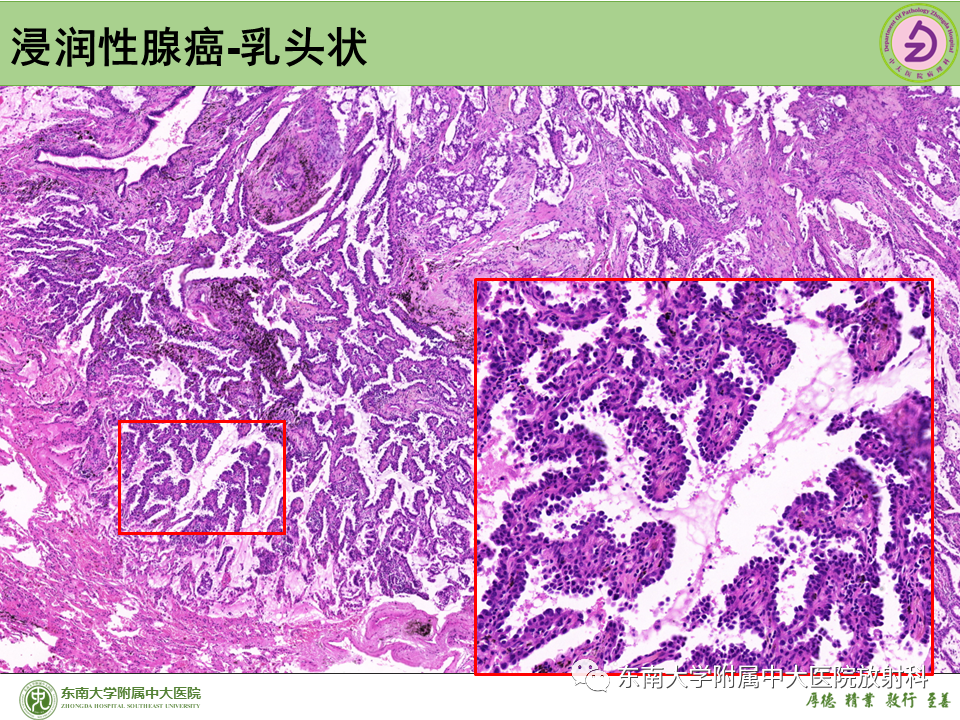 影像PPT - 【PPT】肺结节的鉴别诊断-19 影像PPT - 【PPT】肺结节的鉴别诊断-19