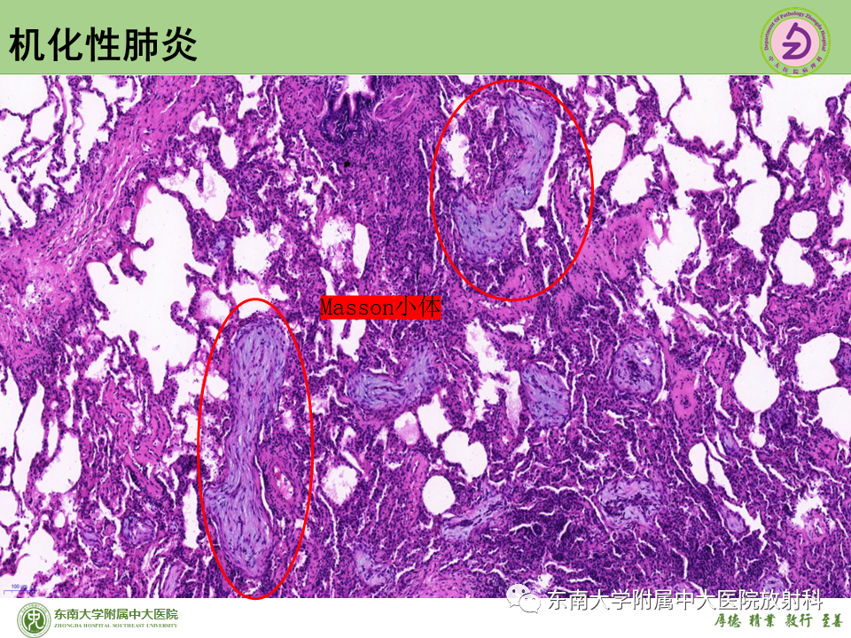 影像PPT - 【PPT】肺结节的鉴别诊断-22 影像PPT - 【PPT】肺结节的鉴别诊断-22