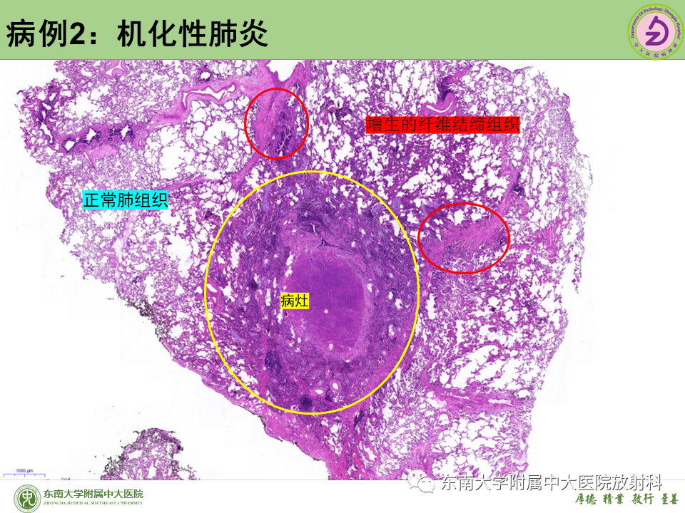 影像PPT - 【PPT】肺结节的鉴别诊断-21 影像PPT - 【PPT】肺结节的鉴别诊断-21