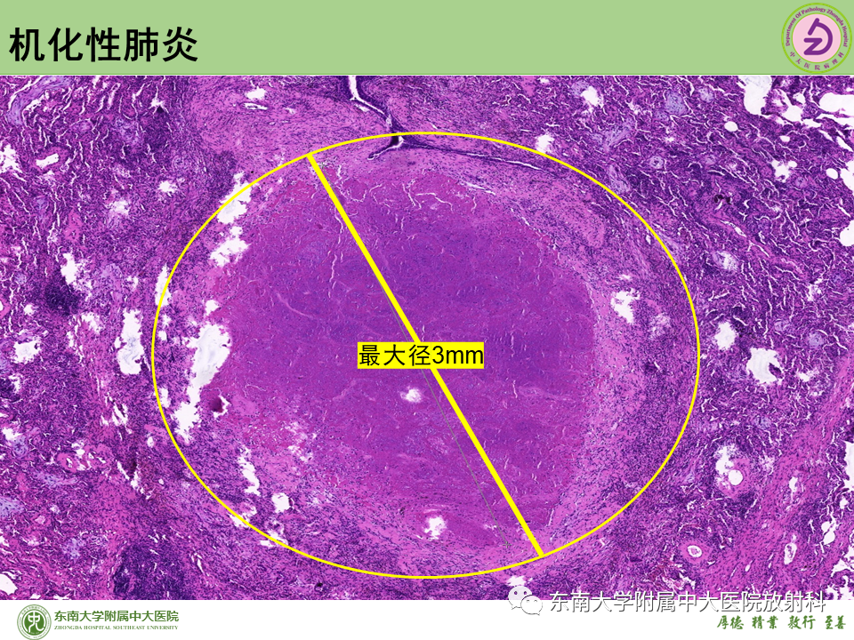 影像PPT - 【PPT】肺结节的鉴别诊断-23 影像PPT - 【PPT】肺结节的鉴别诊断-23
