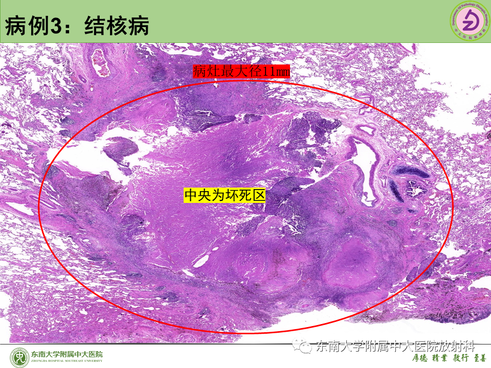 影像PPT - 【PPT】肺结节的鉴别诊断-25 影像PPT - 【PPT】肺结节的鉴别诊断-25