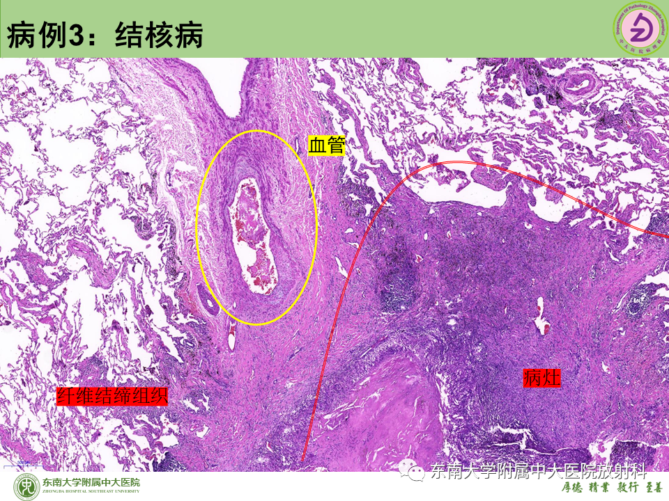 影像PPT - 【PPT】肺结节的鉴别诊断-26 影像PPT - 【PPT】肺结节的鉴别诊断-26