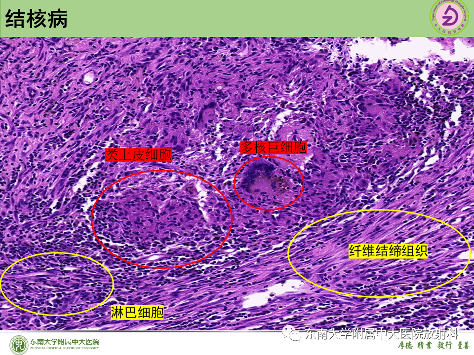 影像PPT - 【PPT】肺结节的鉴别诊断-27 影像PPT - 【PPT】肺结节的鉴别诊断-27