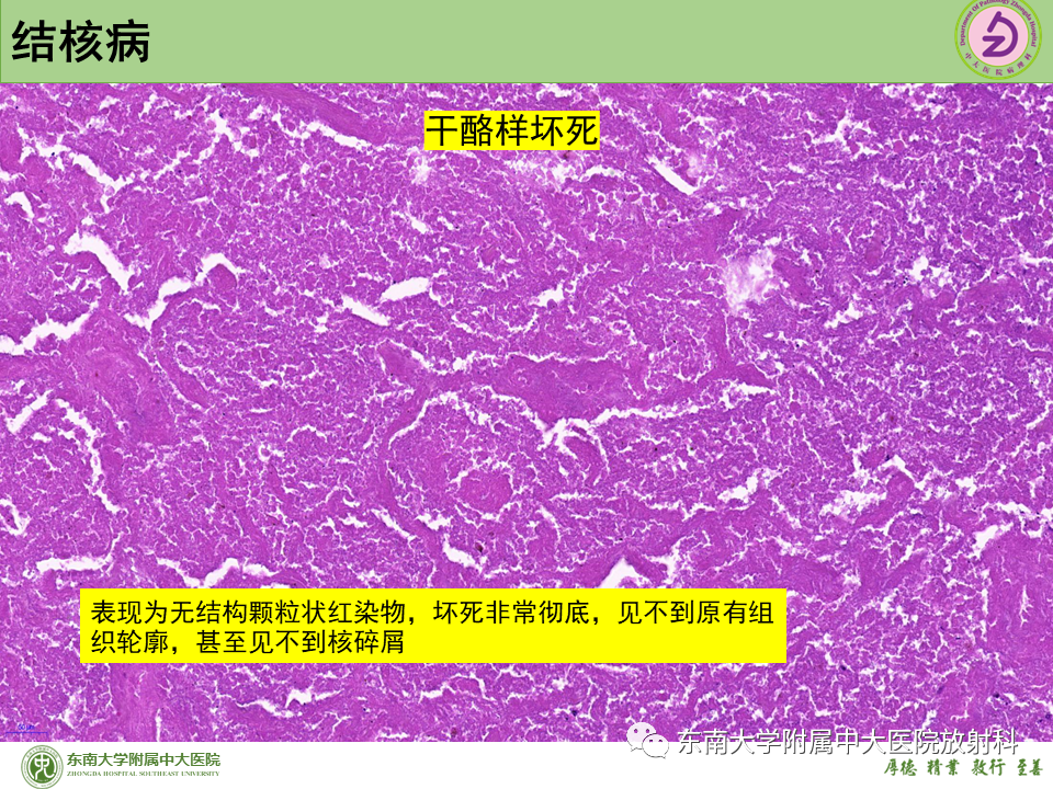 影像PPT - 【PPT】肺结节的鉴别诊断-28 影像PPT - 【PPT】肺结节的鉴别诊断-28