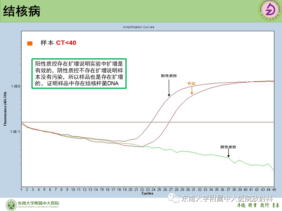 影像PPT - 【PPT】肺结节的鉴别诊断-31 影像PPT - 【PPT】肺结节的鉴别诊断-31