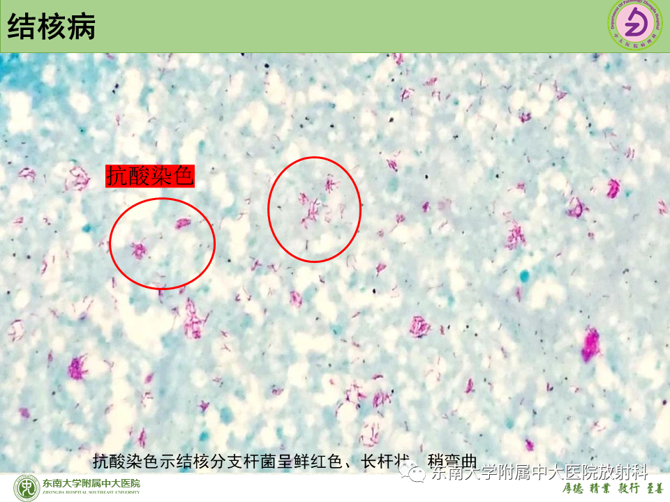 影像PPT - 【PPT】肺结节的鉴别诊断-29 影像PPT - 【PPT】肺结节的鉴别诊断-29