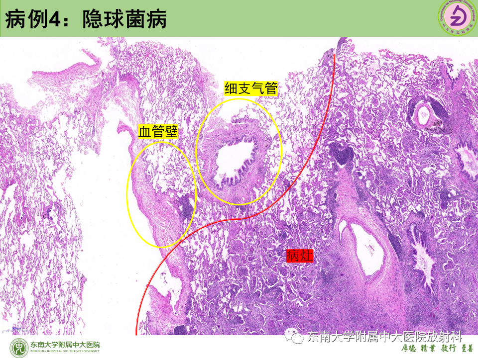 影像PPT - 【PPT】肺结节的鉴别诊断-33 影像PPT - 【PPT】肺结节的鉴别诊断-33