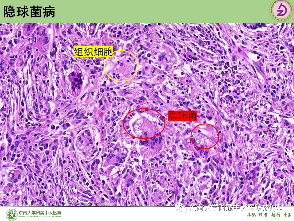 影像PPT - 【PPT】肺结节的鉴别诊断-35 影像PPT - 【PPT】肺结节的鉴别诊断-35