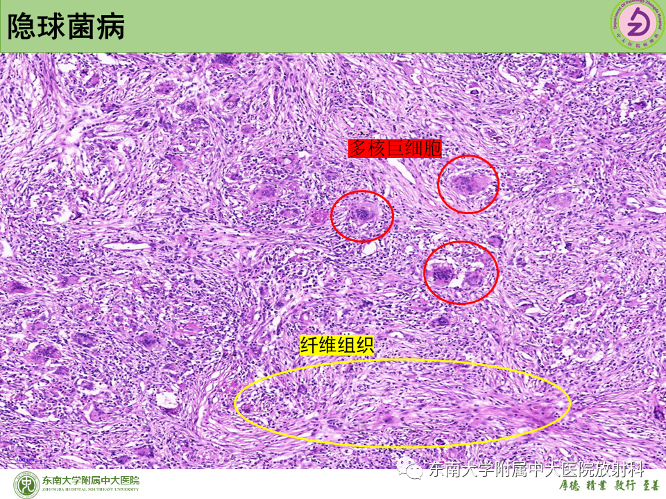 影像PPT - 【PPT】肺结节的鉴别诊断-34 影像PPT - 【PPT】肺结节的鉴别诊断-34