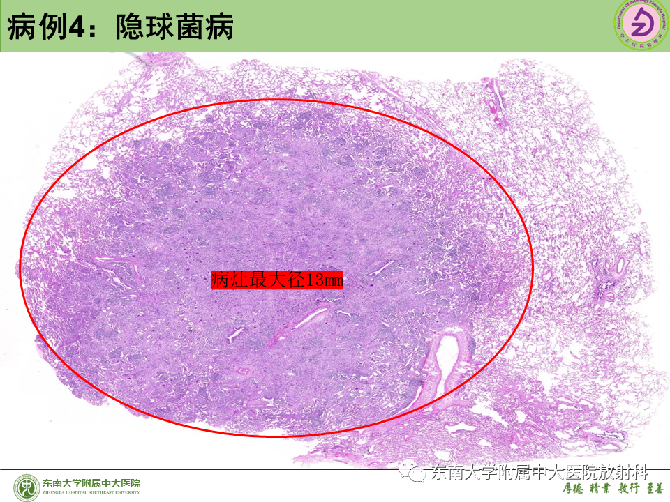 影像PPT - 【PPT】肺结节的鉴别诊断-32 影像PPT - 【PPT】肺结节的鉴别诊断-32