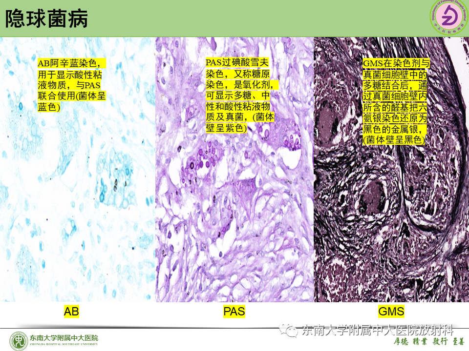 影像PPT - 【PPT】肺结节的鉴别诊断-37 影像PPT - 【PPT】肺结节的鉴别诊断-37