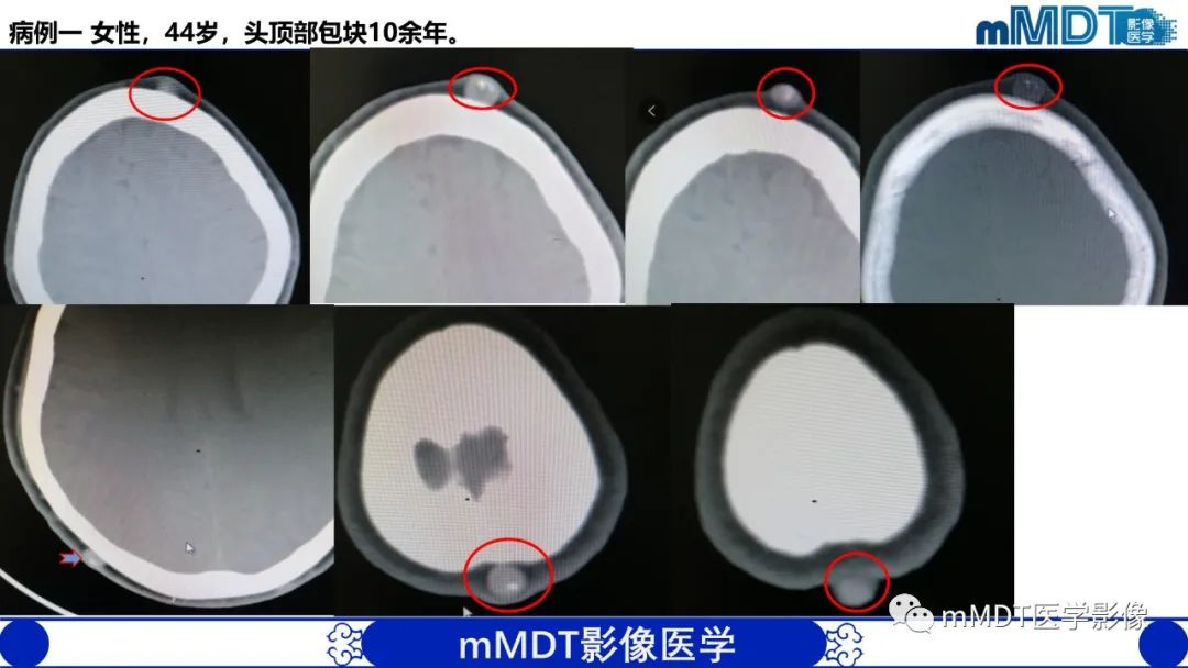 影像PPT - 【PPT】隆起于皮肤的肿瘤探讨-7