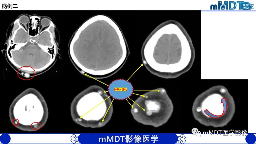 影像PPT - 【PPT】隆起于皮肤的肿瘤探讨-8